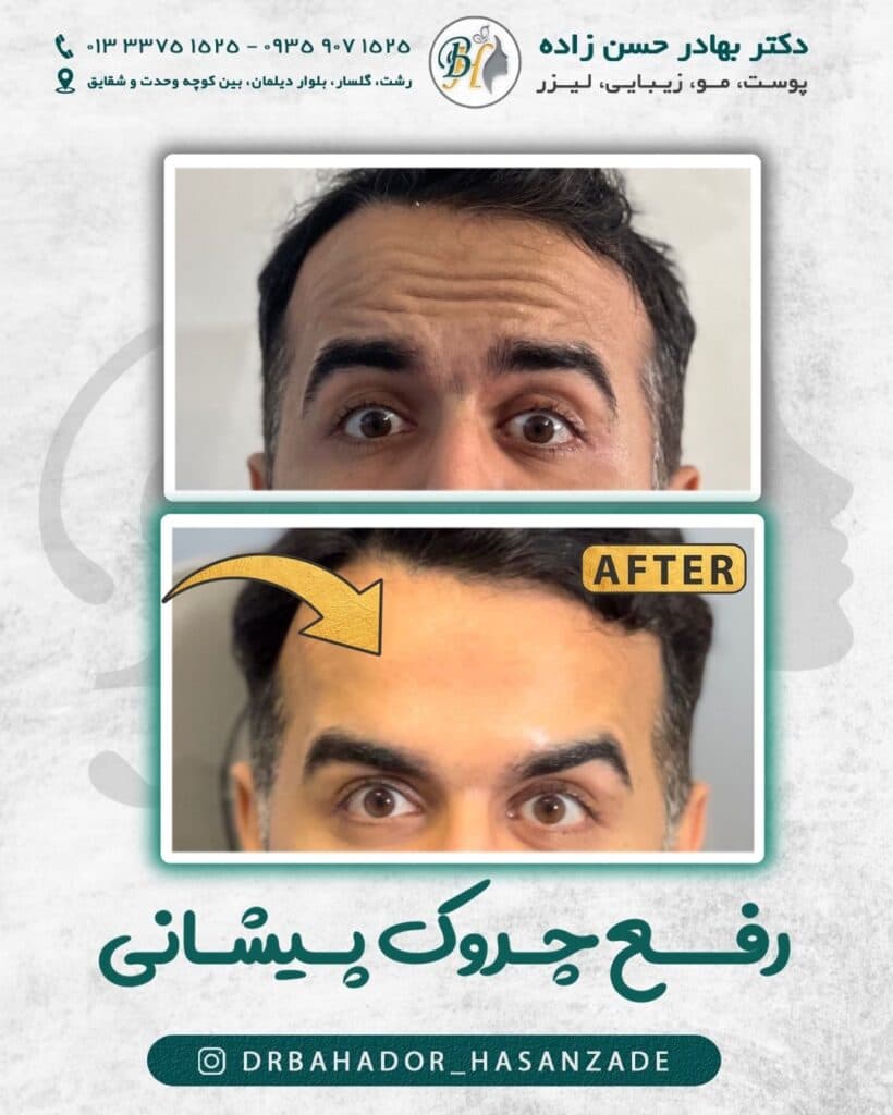 کلینیک زیبایی ژل لب خط خنده گونه دکتر بهادر حسن زاده در گلسار رشت