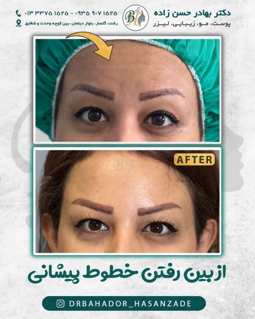 کلینیک زیبایی ژل لب خط خنده گونه دکتر بهادر حسن زاده در گلسار رشت