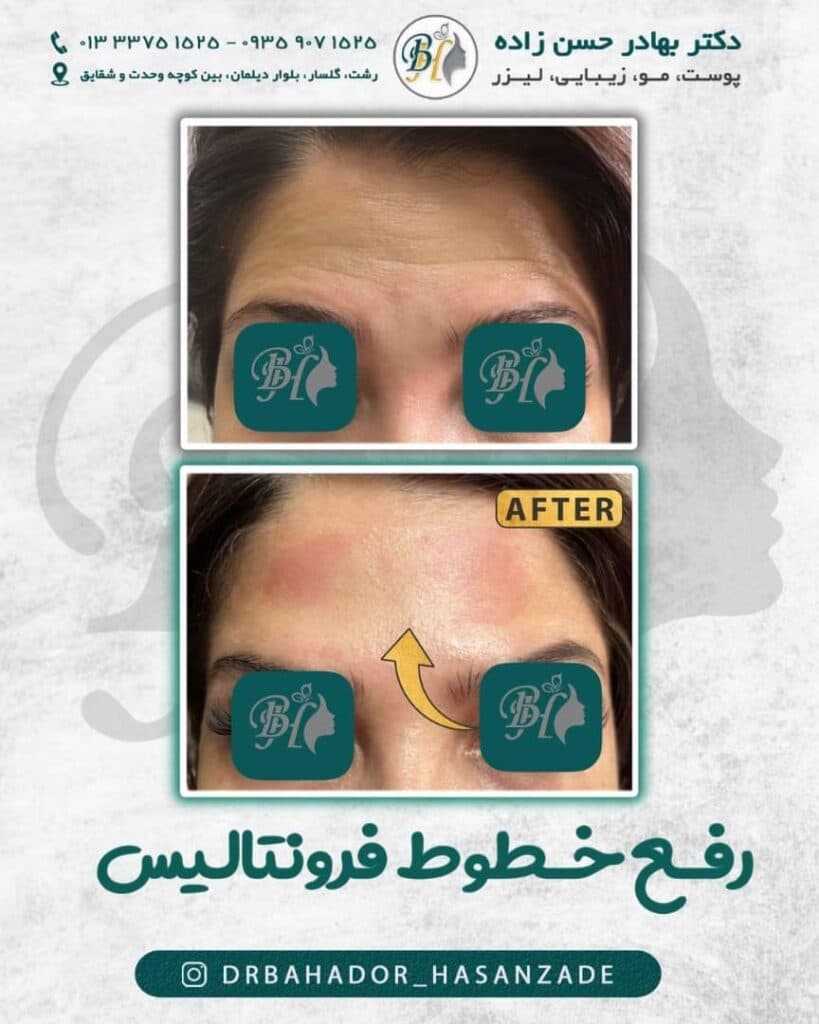 کلینیک زیبایی ژل لب خط خنده گونه دکتر بهادر حسن زاده در گلسار رشت