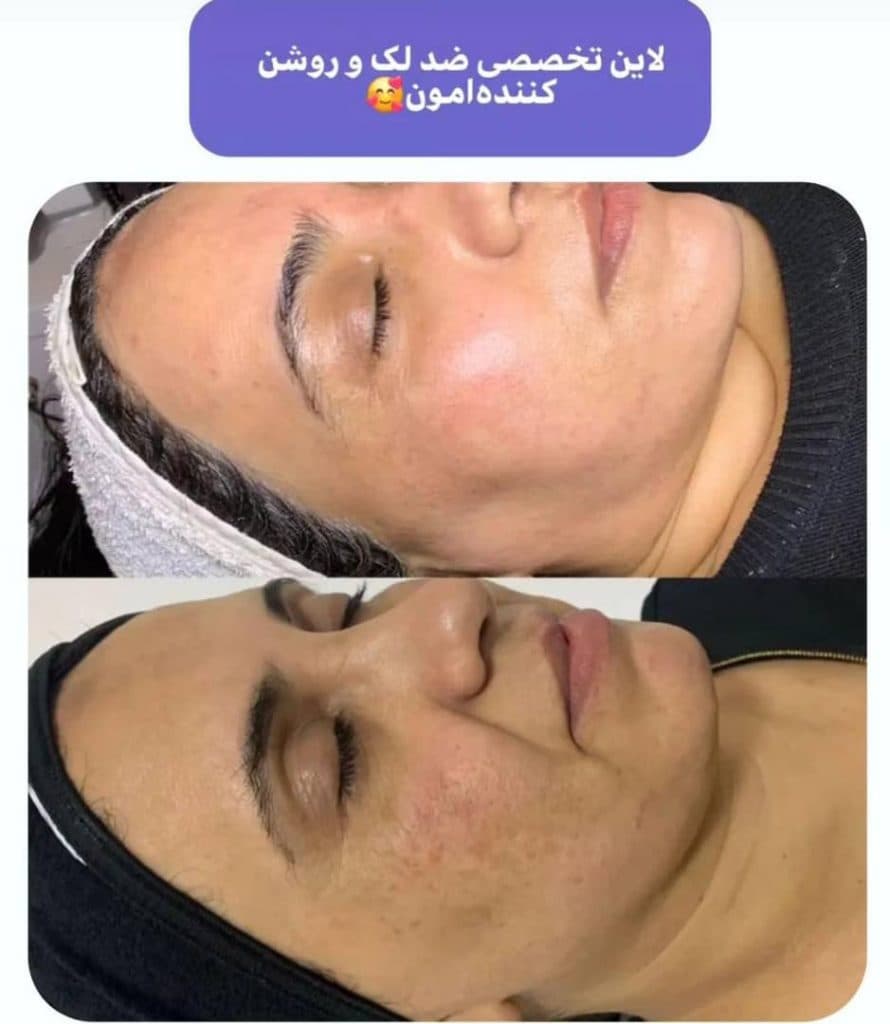 خدمات زیبایی و فیشیال پوست مهسا عبدالعلی زاده در تهران