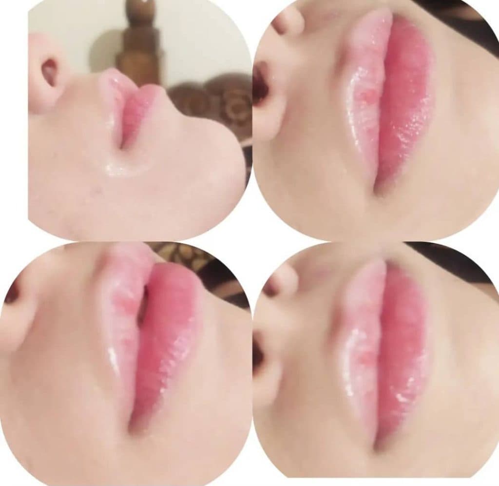 تزریق ژل و بوتاکس هیوا خسروی در هشتگرد