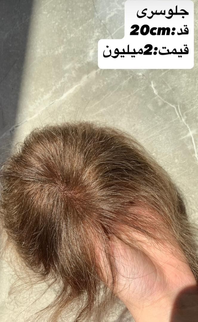 تولید عمده پروتز مو طبیعی جلوسری بالاسری تمام سری gilan wig تهران