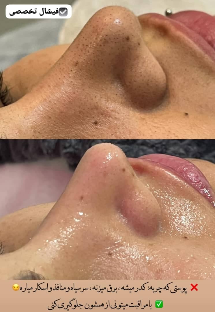 آموزش خدمات پاکسازی و مراقبت از پوست زینب نبی زاده در بابل