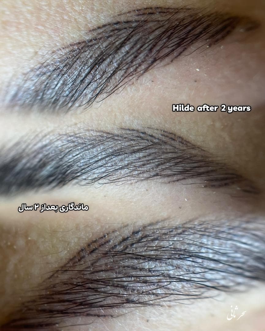 میکروپیگمنتیشن صورت و میکروبلیدینگ سحر ثانی در رشت