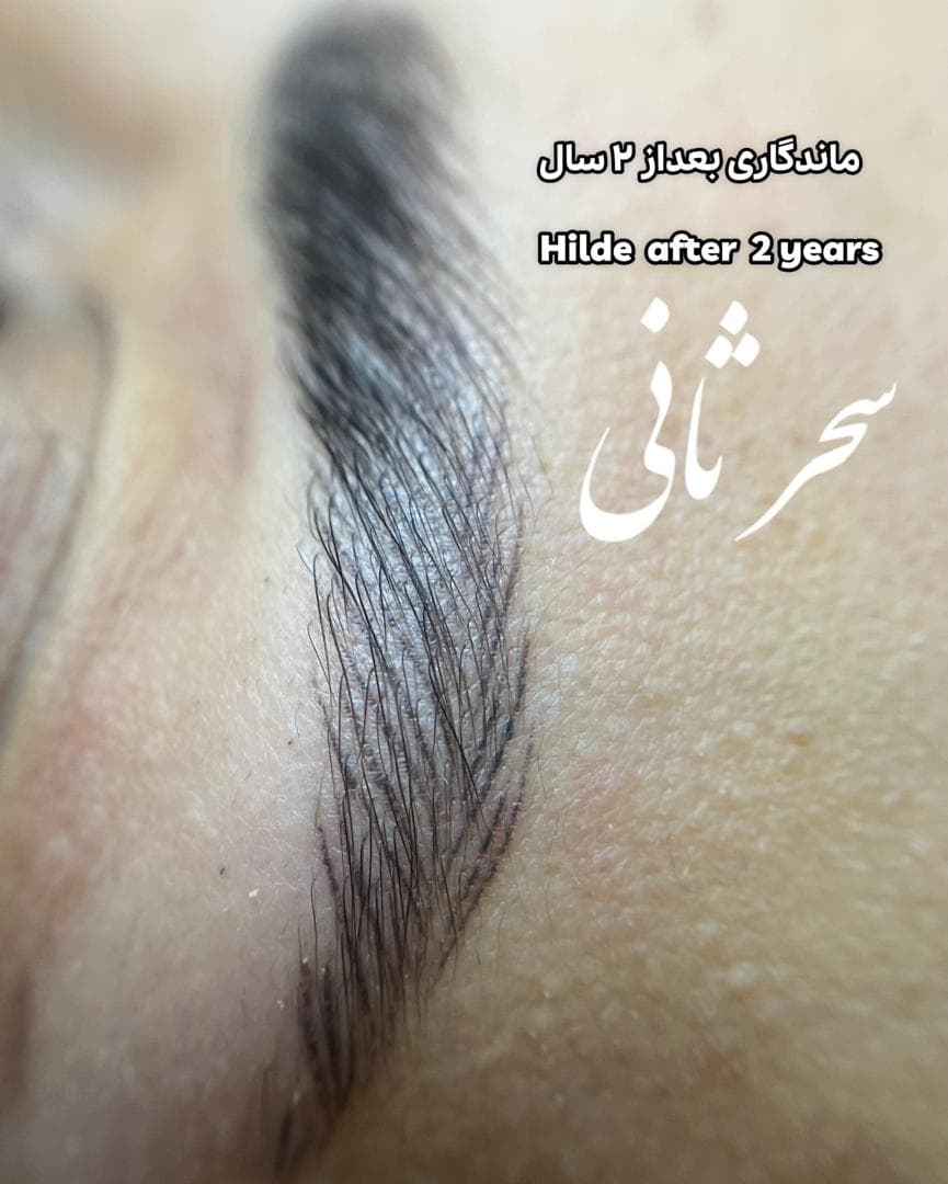 میکروپیگمنتیشن صورت و میکروبلیدینگ سحر ثانی در رشت