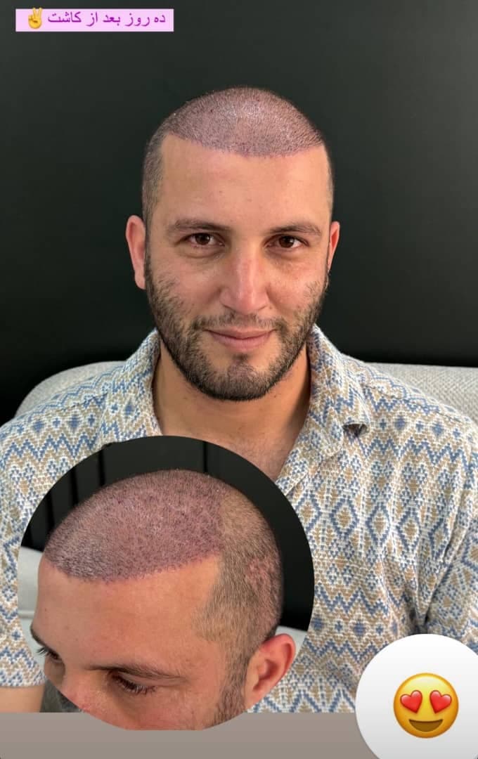 خدمات تخصصی کاشت مو به روش fit ماندانا حاجی در بابل