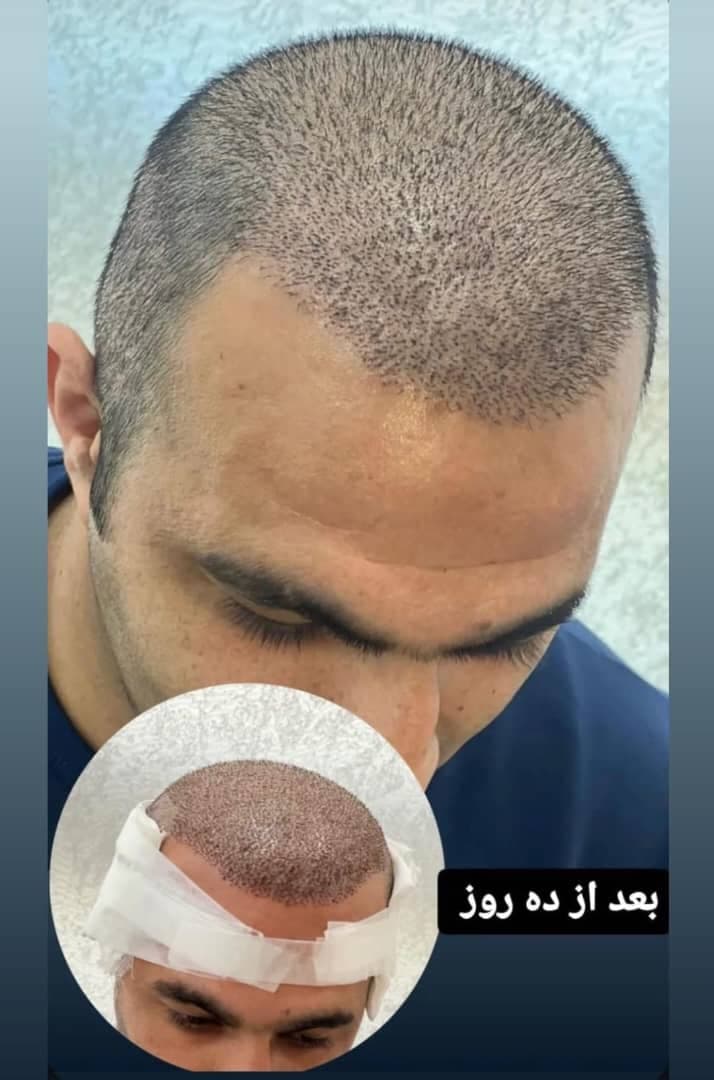 خدمات تخصصی کاشت مو به روش fit ماندانا حاجی در بابل