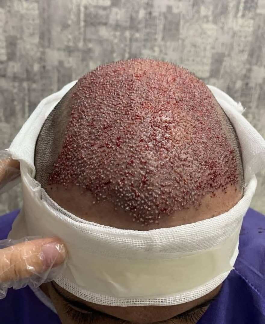 خدمات تخصصی کاشت مو به روش fit ماندانا حاجی در بابل