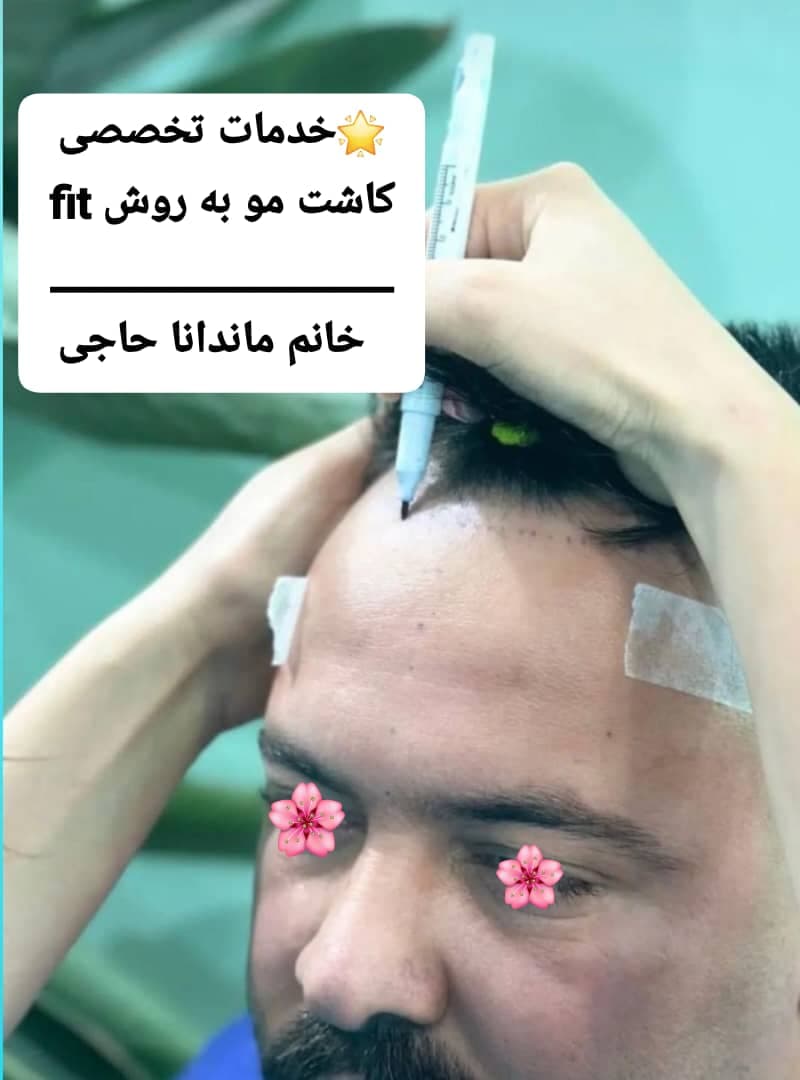 خدمات تخصصی کاشت مو به روش fit ماندانا حاجی در بابل