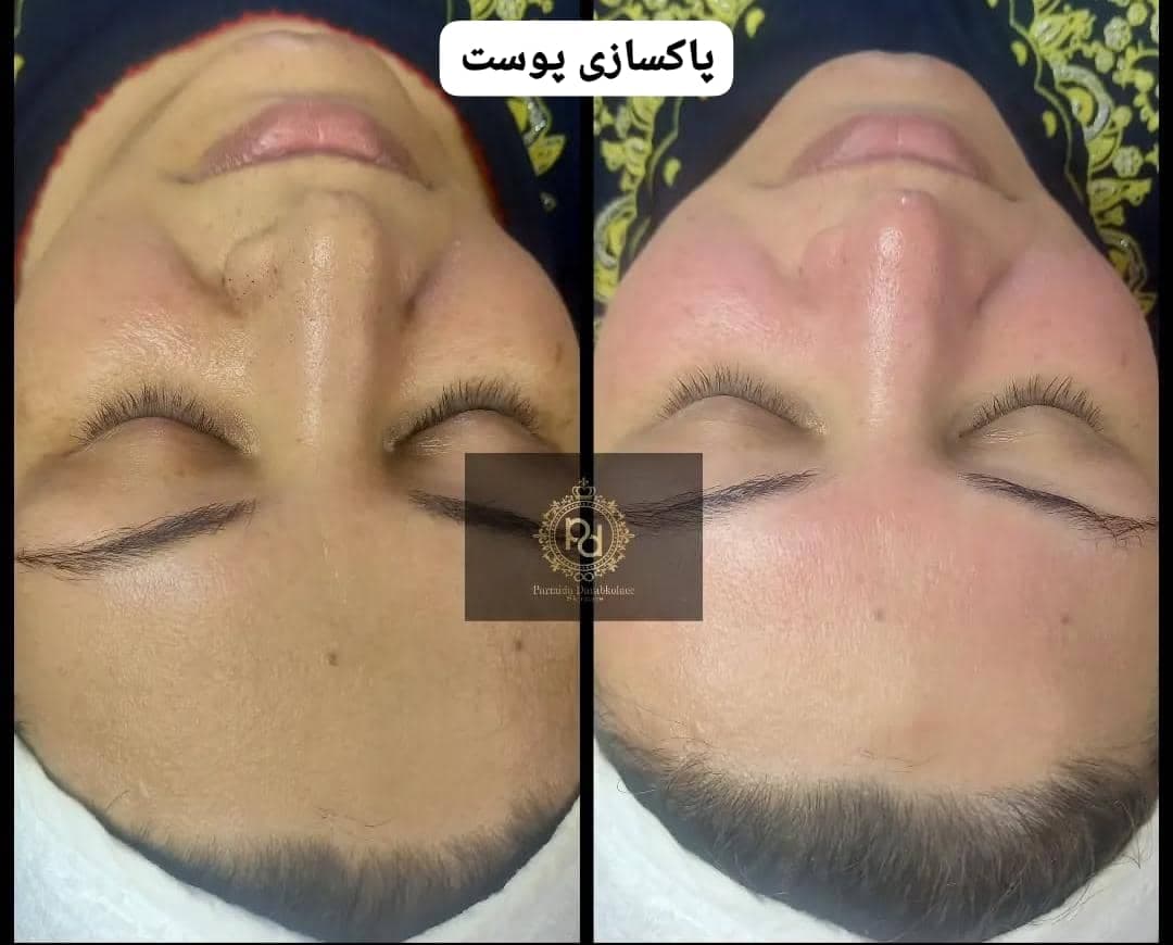 کلینیک تخصصی زیبایی ریمو تاتو با لیزر پارمیدا در ساری