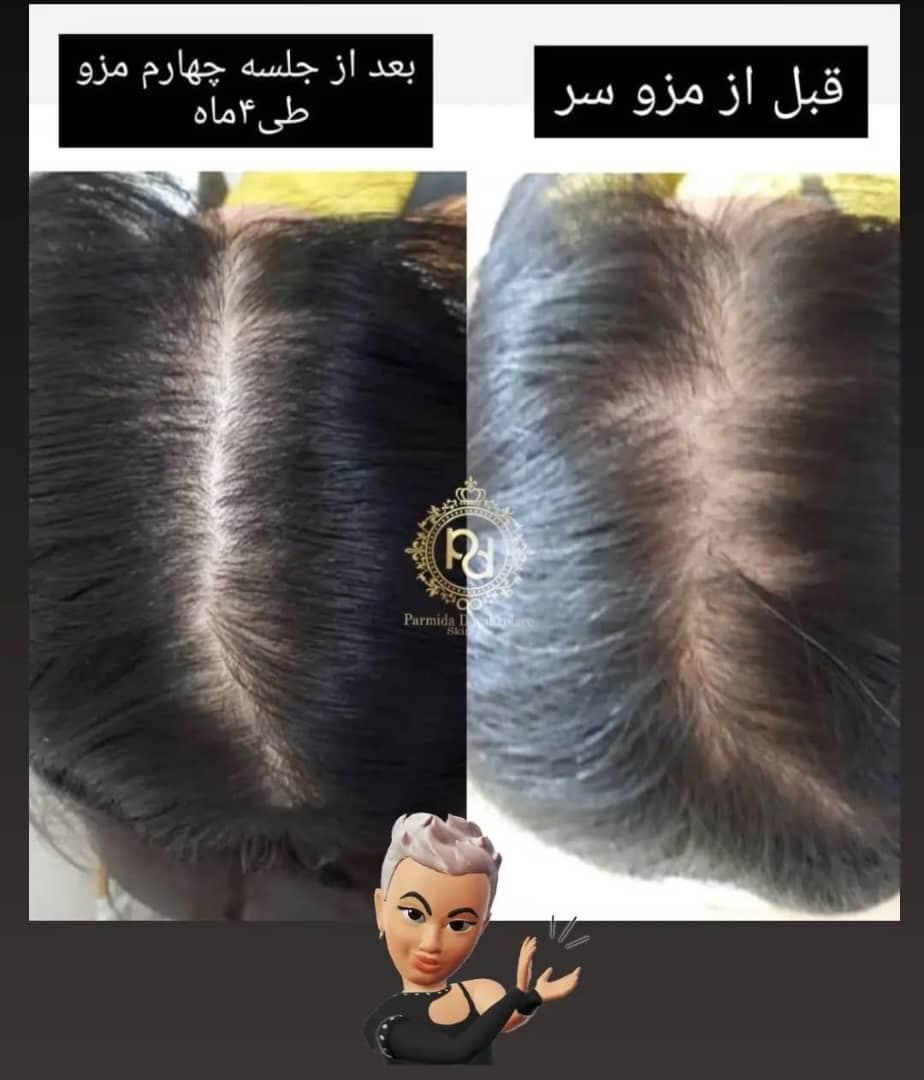 کلینیک تخصصی زیبایی ریمو تاتو با لیزر پارمیدا در ساری