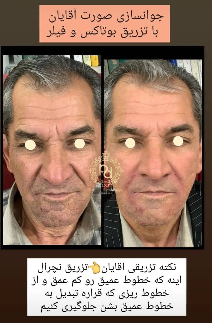 کلینیک تخصصی زیبایی ریمو تاتو با لیزر پارمیدا در ساری