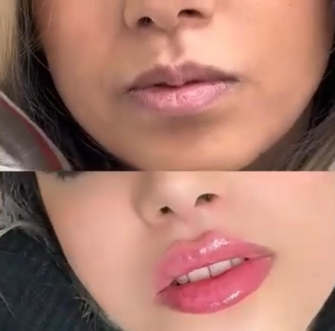 آموزش فیلر و بوتاکس آکادمی دکتر سهرابی در نوبهار کرمانشاه