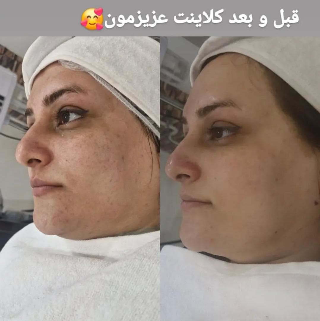 آموزش فیشیال و لیزر موهای زائد آکادمی دکتر سهرابی در نوبهار کرمانشاه