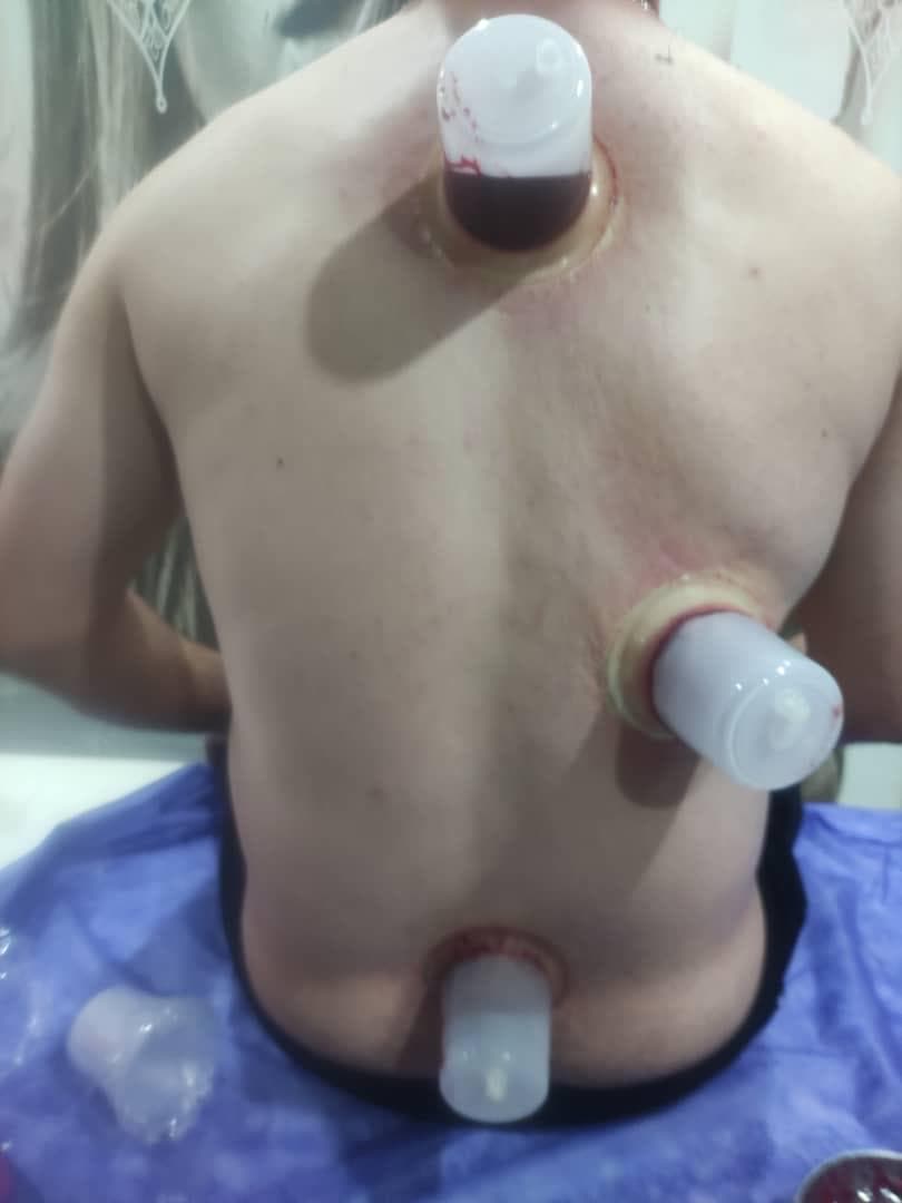 خدمات تخصصی حجامت و زالو درمانی رایحه سیب طبیب امکی در ایلام