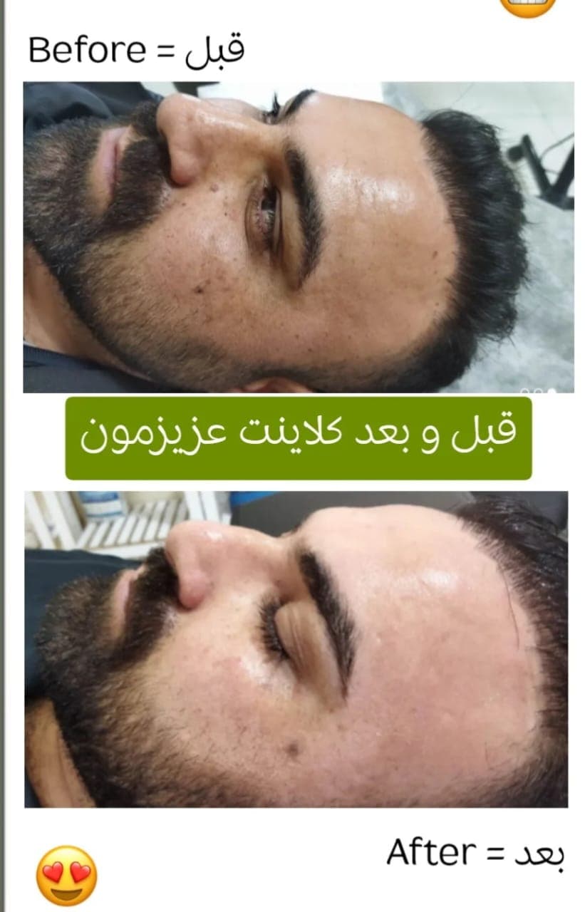 آموزش و درمان جوش و اسکار مرضیه سجادیان در کرمانشاه