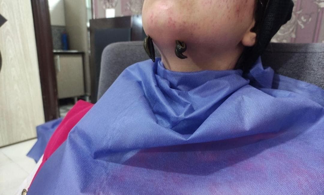 خدمات تخصصی حجامت و زالو درمانی رایحه سیب طبیب امکی در ایلام