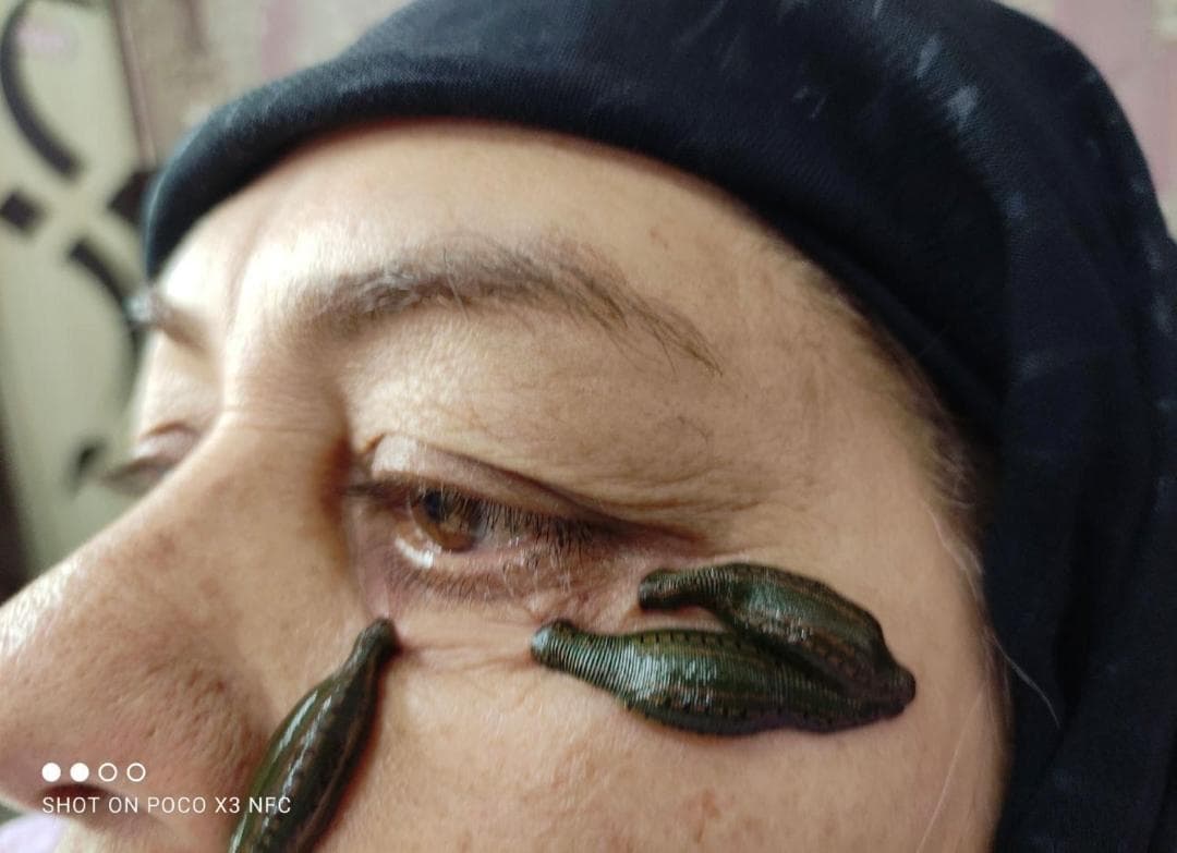 خدمات تخصصی حجامت و زالو درمانی رایحه سیب طبیب امکی در ایلام